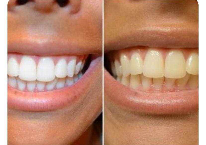 NKDSTORE™  Dentrifice Blanchissant à la Niacinamide.